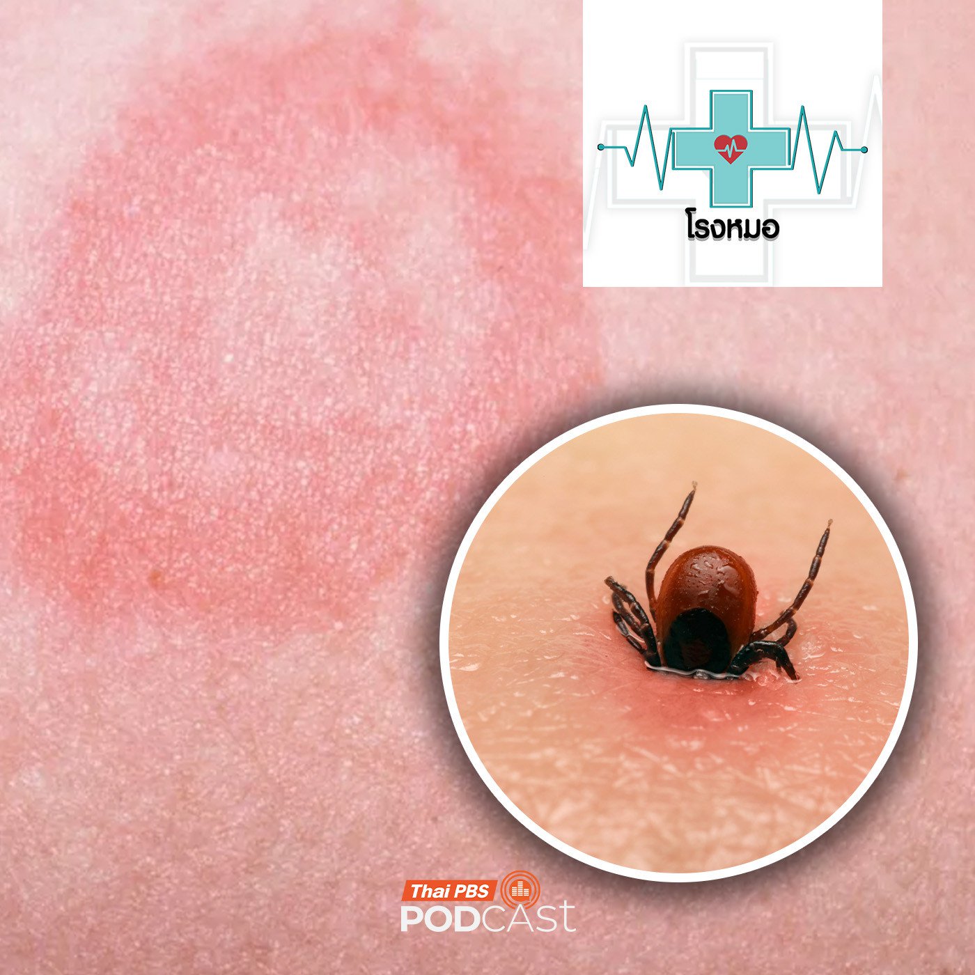 โรงหมอ EP. 1170: "ไลม์" โรคจากเห็บ เป็นแล้วเหมือนไม่มีอะไร ไม่รักษาเสี่ยงตายได้ โรงหมอ EP. 1170: "ไลม์" โรคจากเห็บ เป็นแล้วเหมือนไม่มีอะไร ไม่รักษาเสี่ยงตายได้